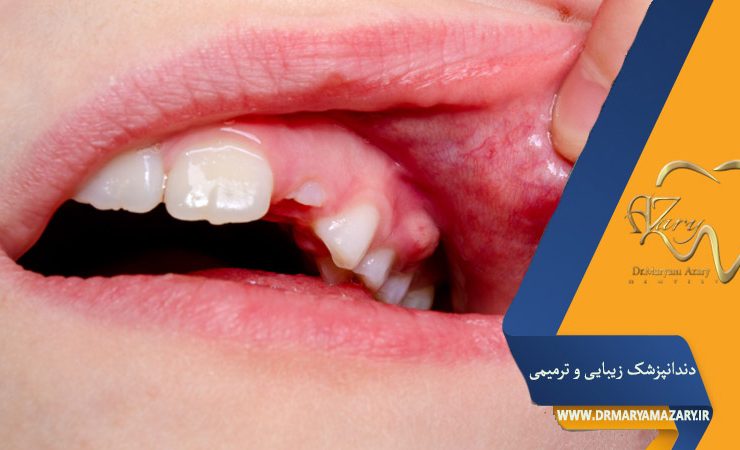 درمان آبسه لثه بدون آنتیبیوتیک