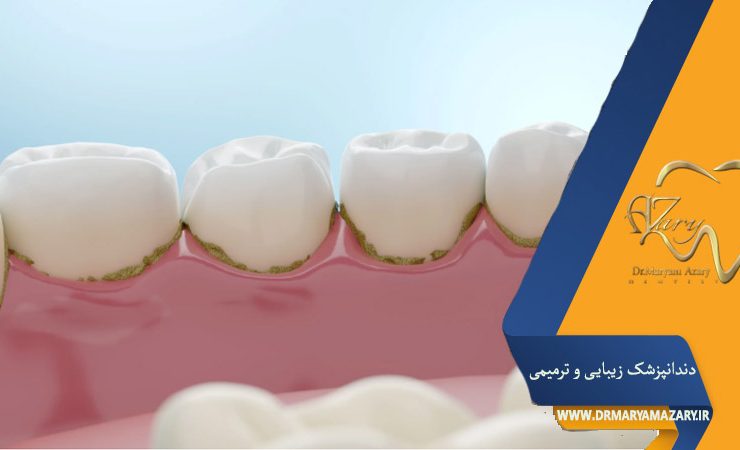 روش های جلوگیری از تشکیل جرم دندان