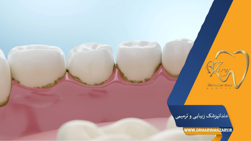 روش های جلوگیری از تشکیل جرم دندان