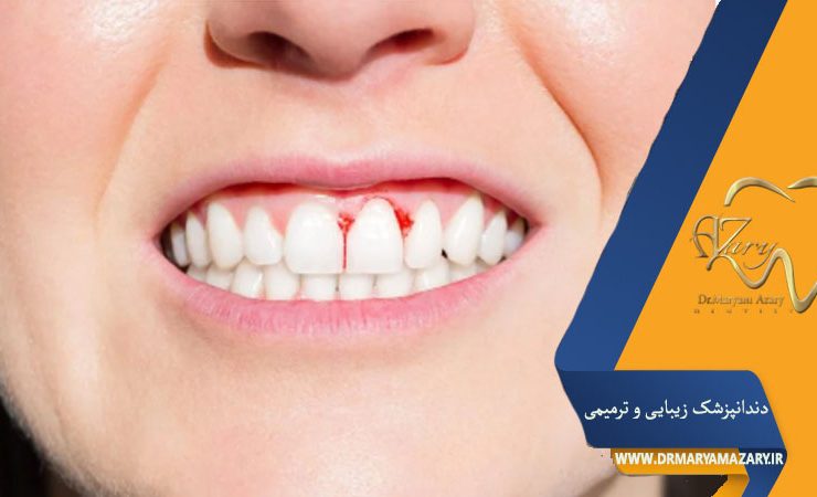 کمبود ویتامین C و خونریزی لثه