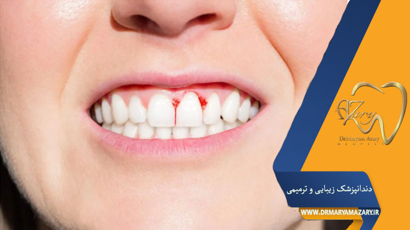 کمبود ویتامین C و خونریزی لثه