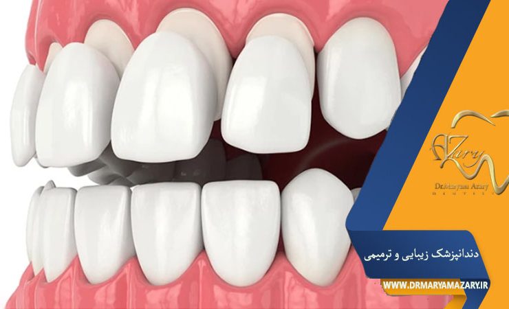 تفاوت لمینت سرامیکی و کامپوزیتی چیست؟