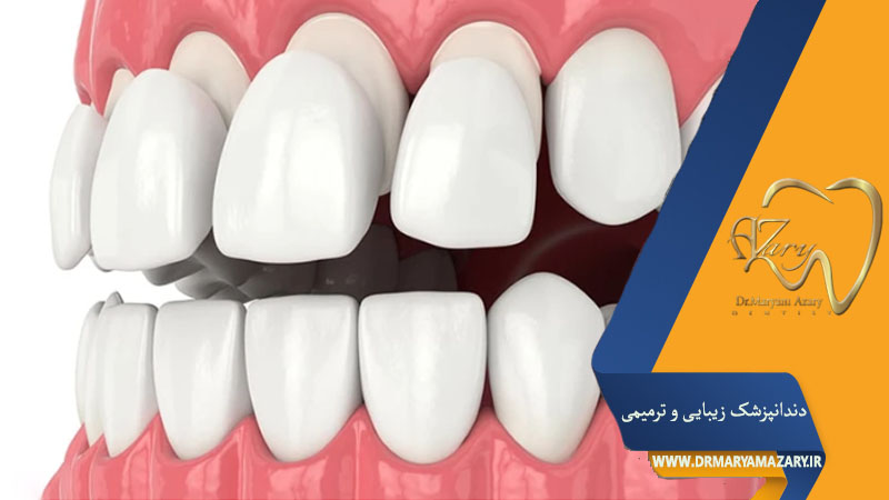 تفاوت لمینت سرامیکی و کامپوزیتی چیست؟