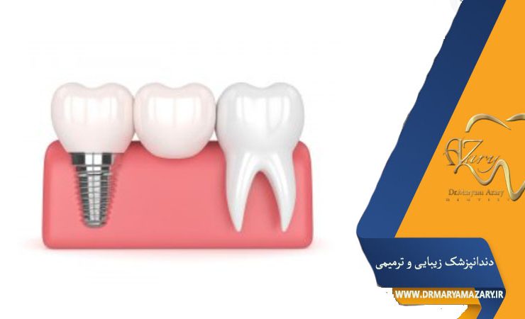 ایمپلنت یا بریج