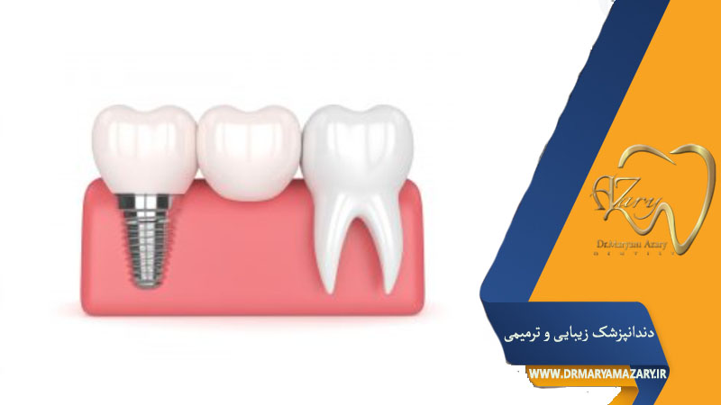 ایمپلنت یا بریج