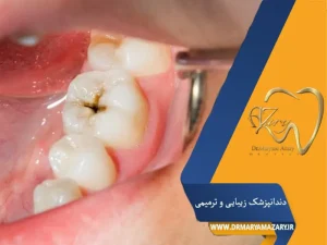 چرا دندانها پوسیده میشوند؟