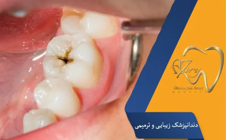چرا دندانها پوسیده میشوند؟