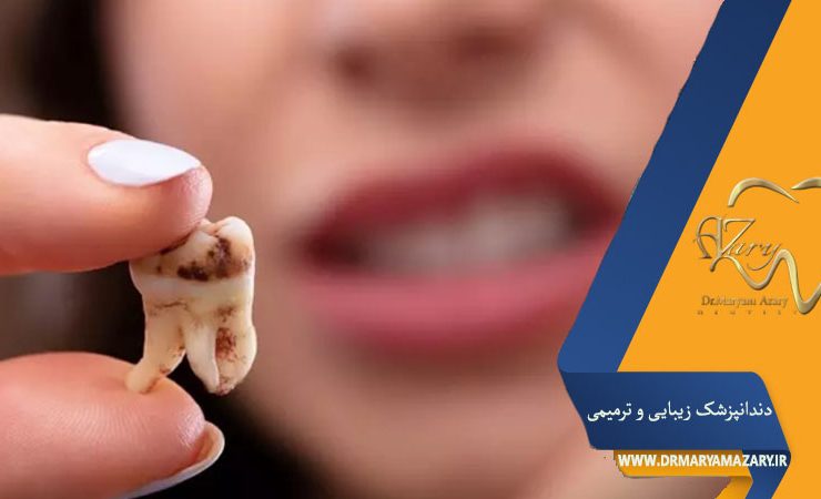 پوسیدگی دندان در کودکان