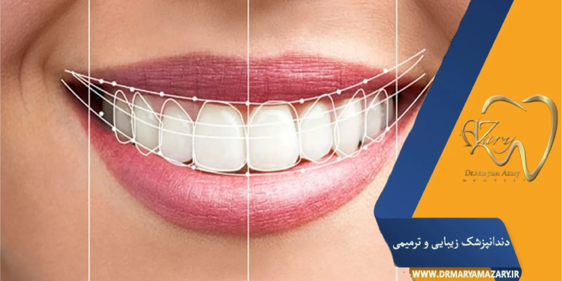 آیا لمینت دندان قابل ترمیم است؟