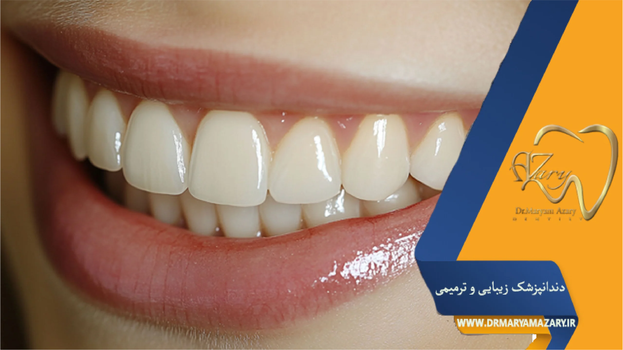 اصلاح لبخند لثه‌ای