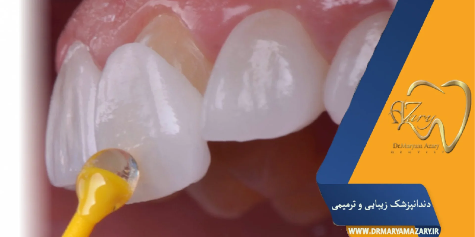 طول عمر لمینت دندان چقدر است؟