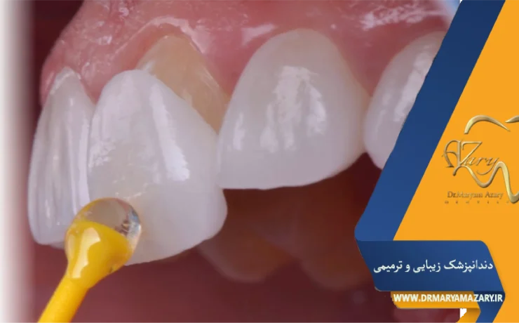 طول عمر لمینت دندان چقدر است؟