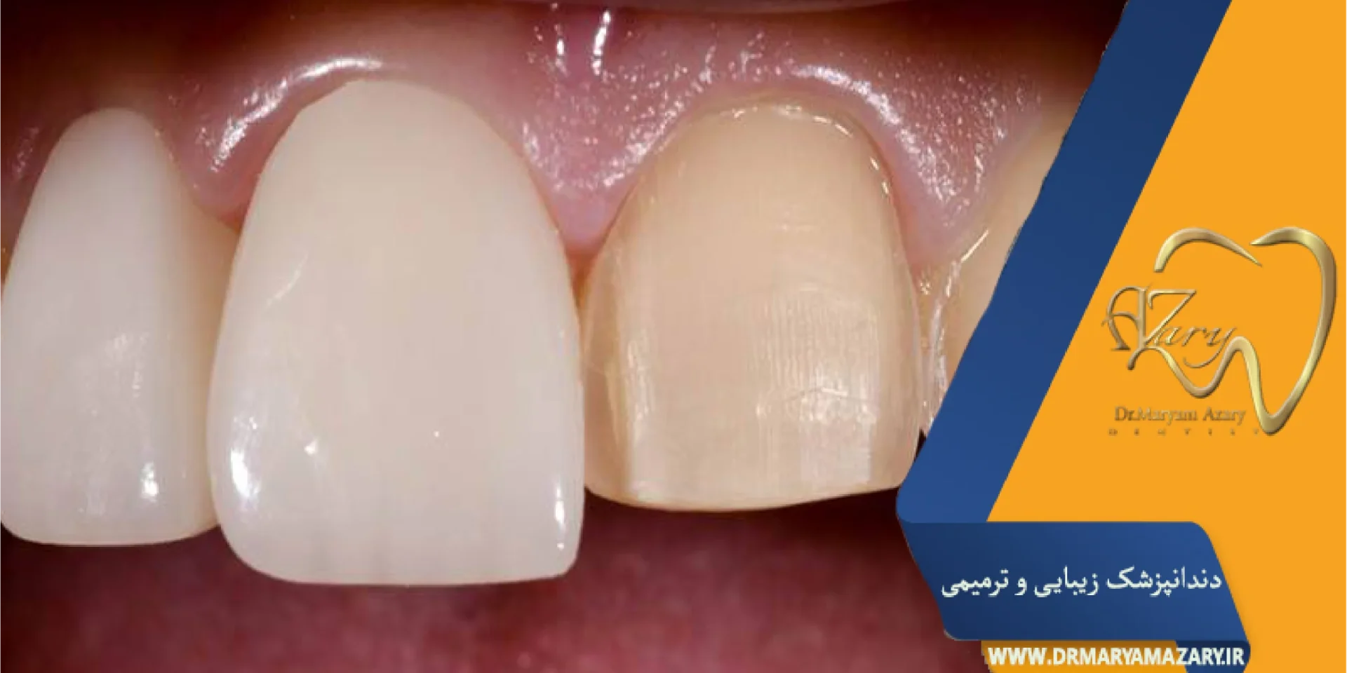 فرق روکش دندان و لمینت