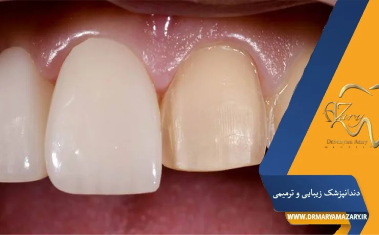 فرق روکش دندان و لمینت