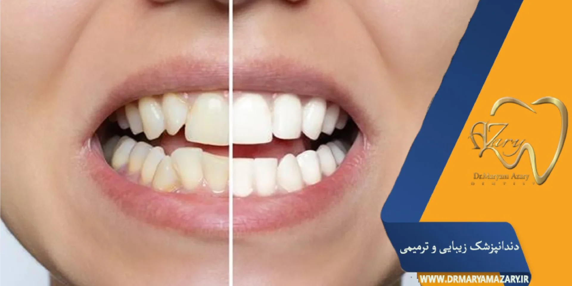 بلیچینگ‌در مطب یا خانه؟