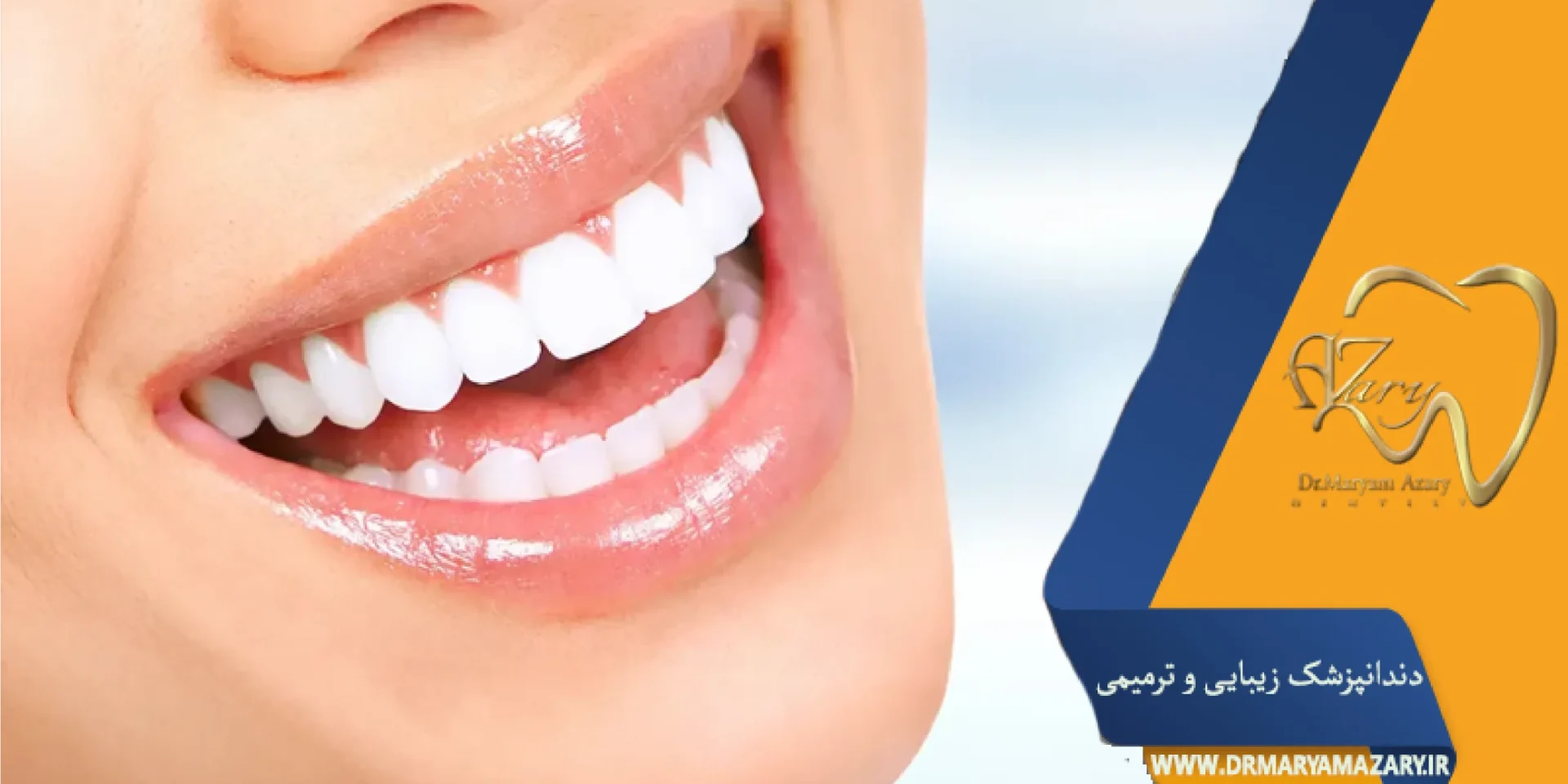 لبخند هالیوودی