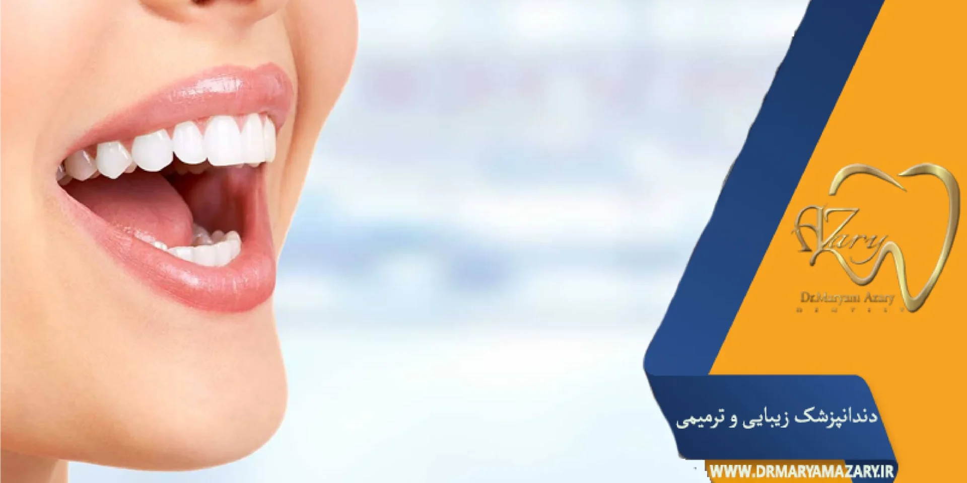 لمینت یا روکش سرامیکی