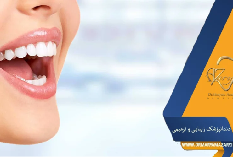 لمینت یا روکش سرامیکی