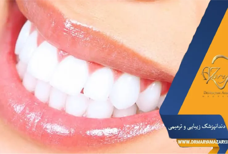 بلیچینگ در مطب یاخانه