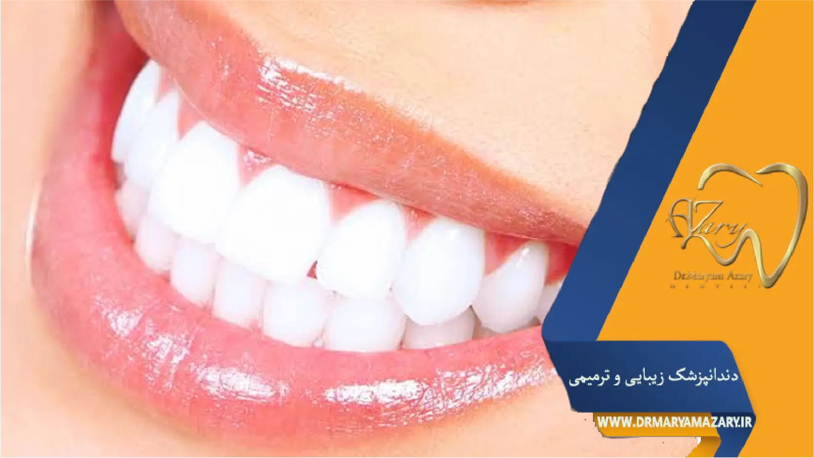 بلیچینگ در مطب یاخانه