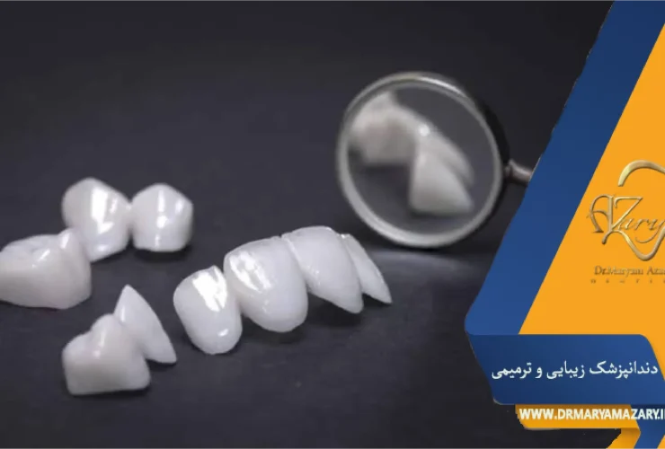 مراقبت بعد از کامپوزیت