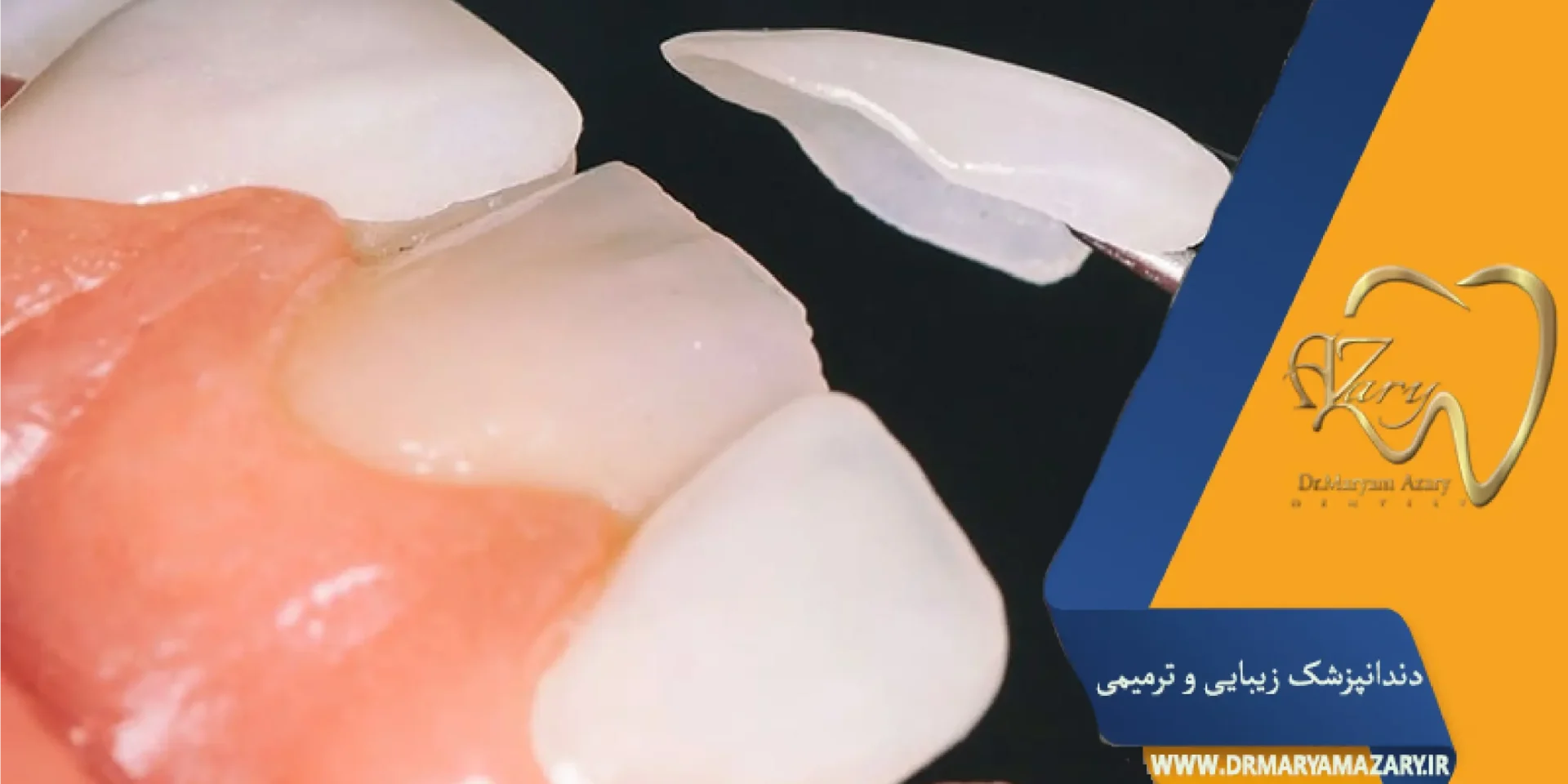 مصنوعی بودن لمینت