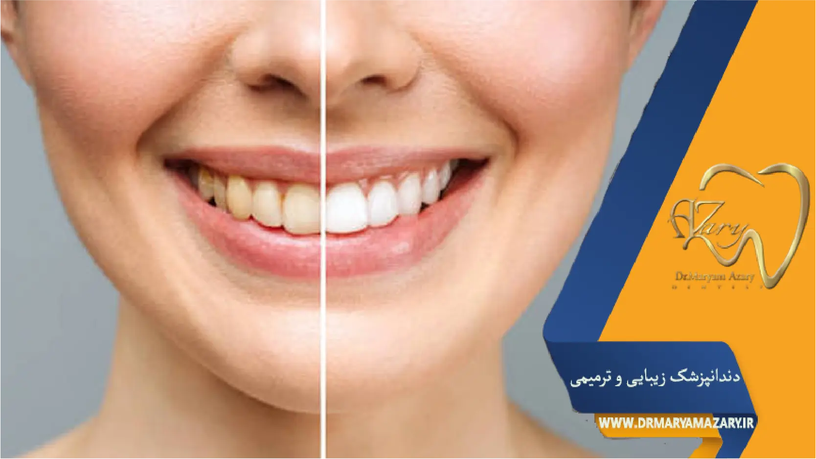 معاینات قبل‌از اصلاح لبخند