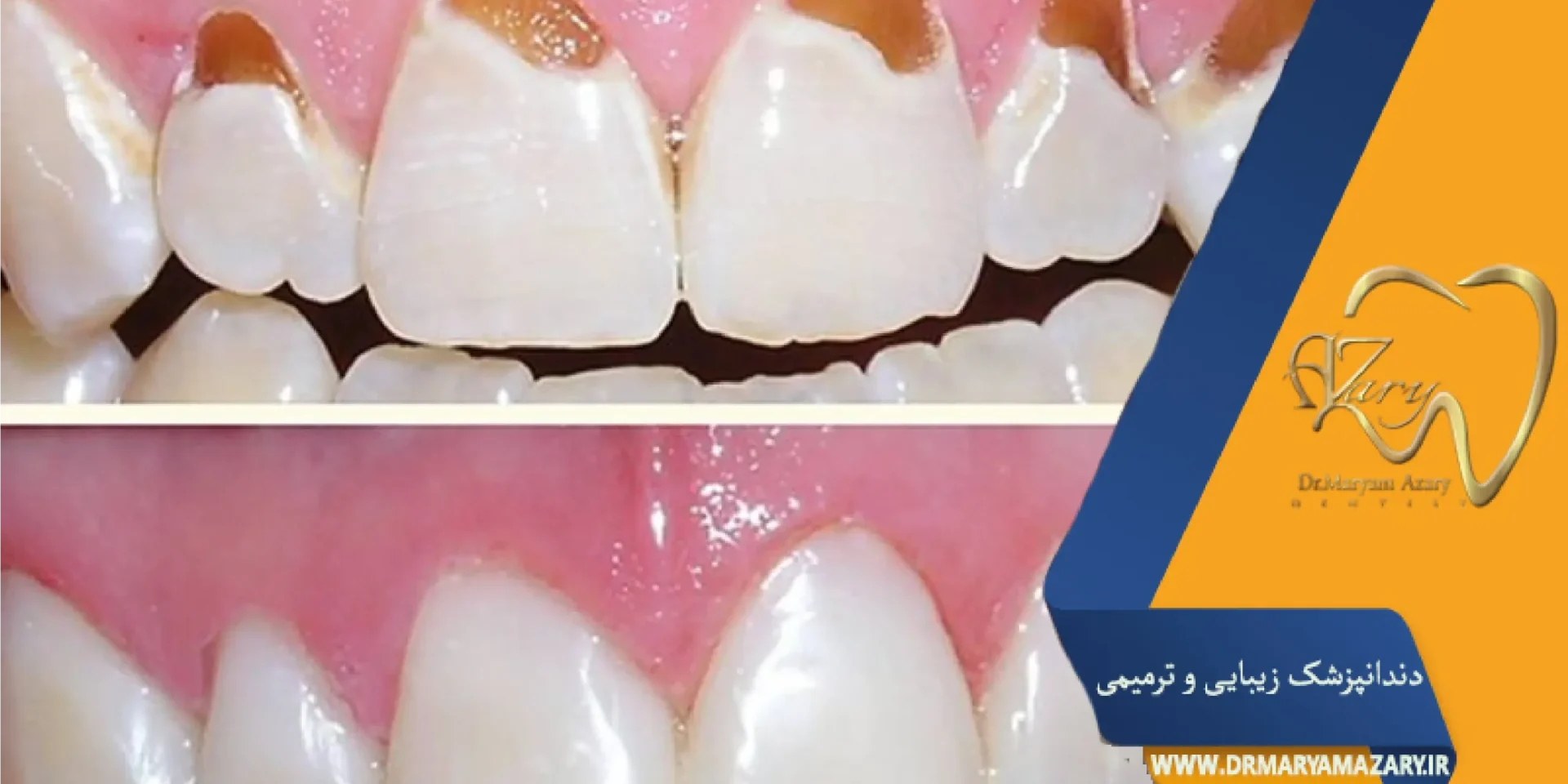 مواد مناسب پرکردن دندان