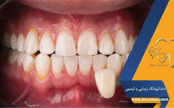 نشانه زمان تعویض لمینت