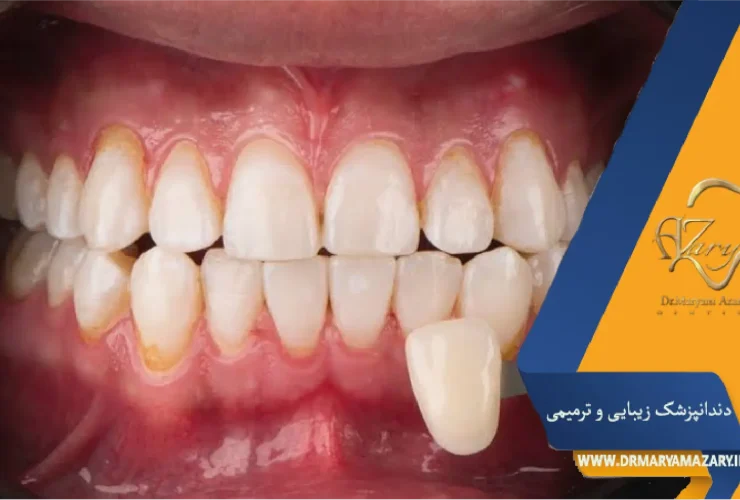 نشانه زمان تعویض لمینت