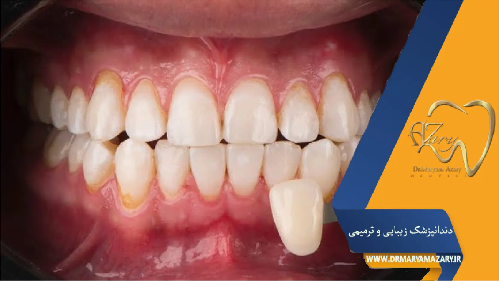 نشانه زمان تعویض لمینت