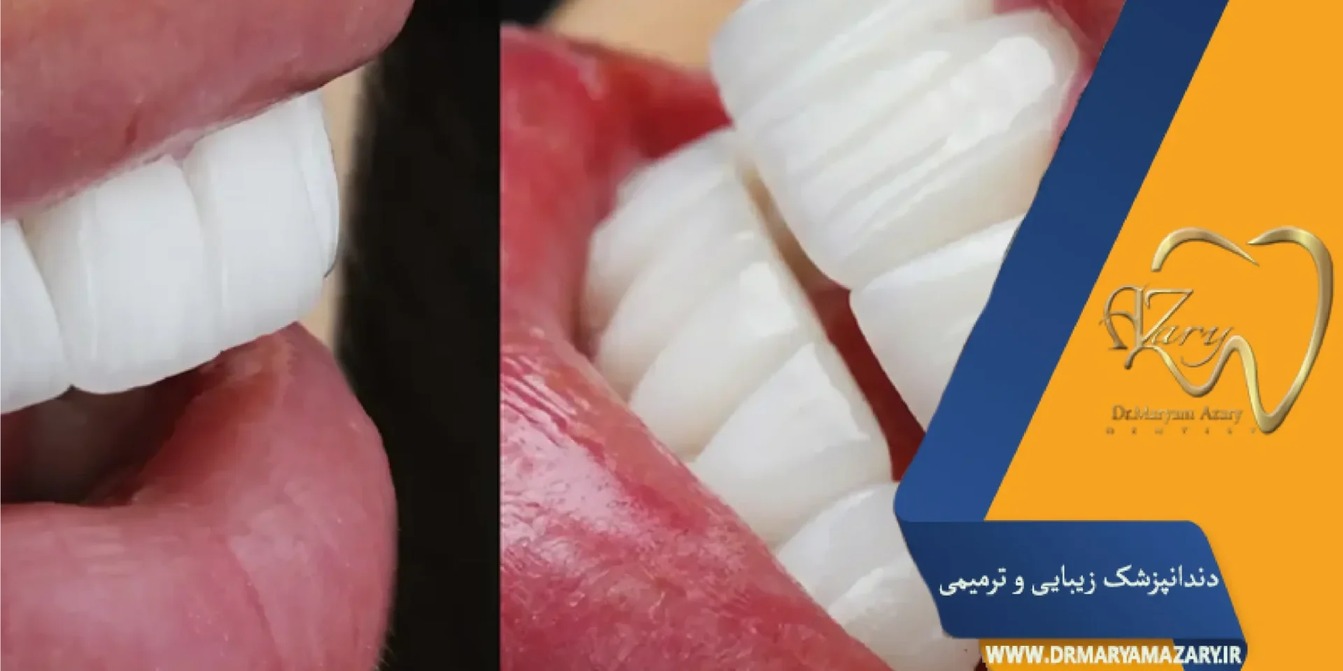 چگونگی کامپوزیت دندان جلو